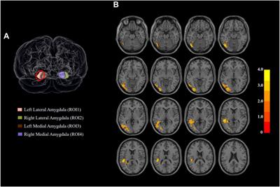 Hyperconnectivity of the lateral amygdala in long-term methamphetamine abstainers negatively correlated with withdrawal duration